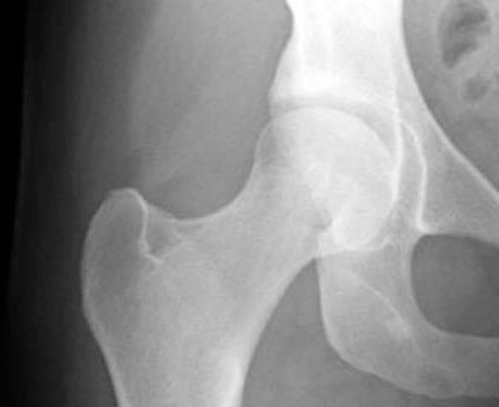 OSTEONECROSI