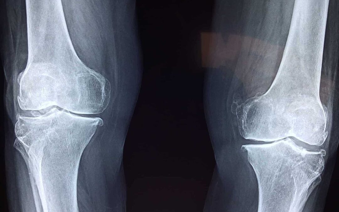 Edema Osseo: Come Curarlo