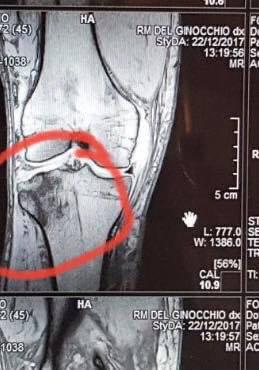 Edema Osseo: Come Curarlo