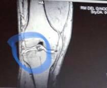 Edema Osseo: Come Curarlo